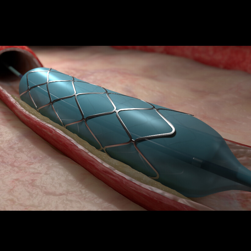 Coronary Stent Deployment