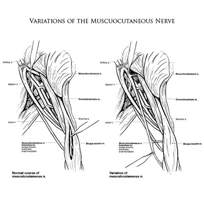 Variations of the Musculocutaneous Nerve