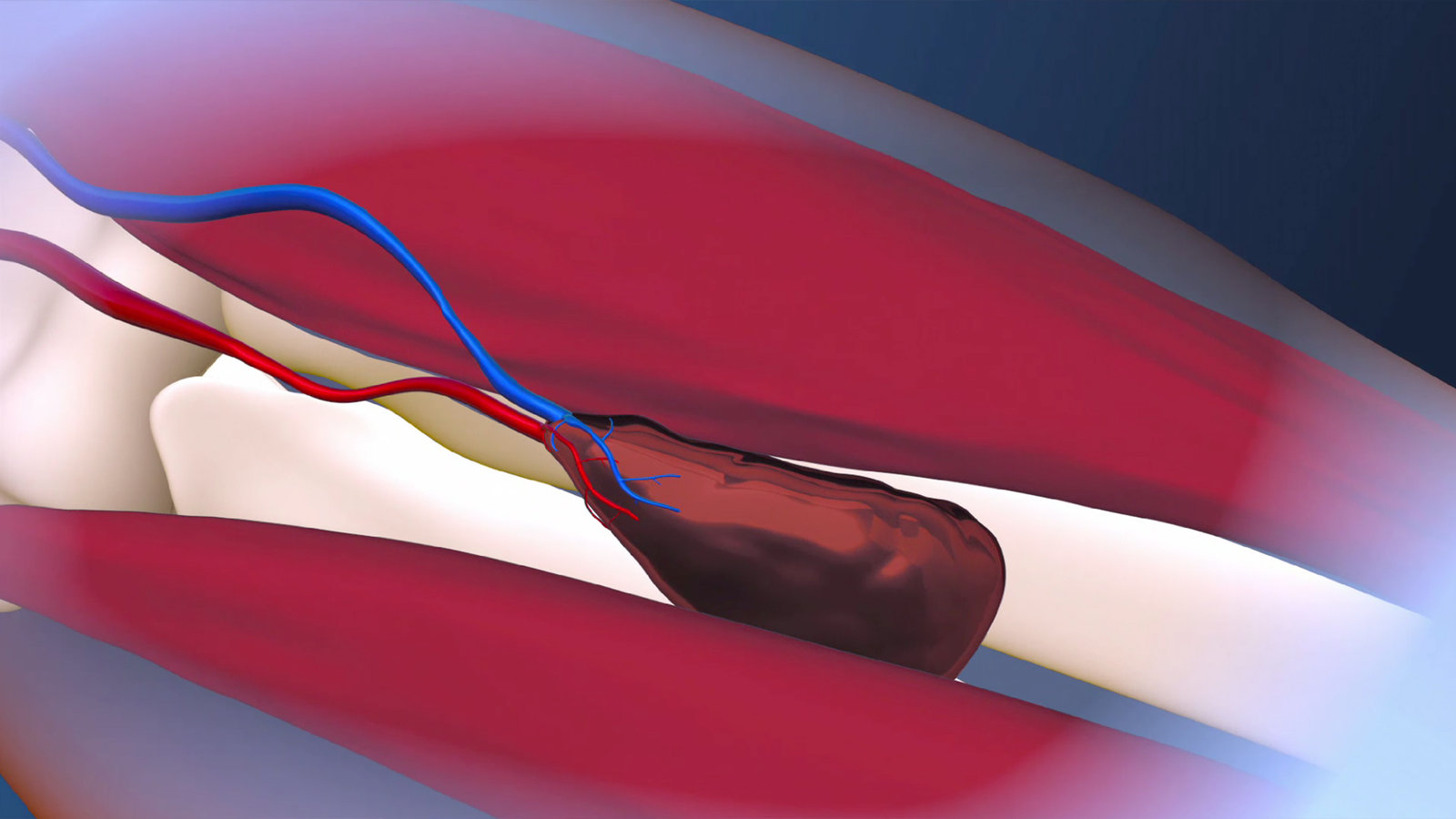 Still from an animation I created showing a new surgical technique