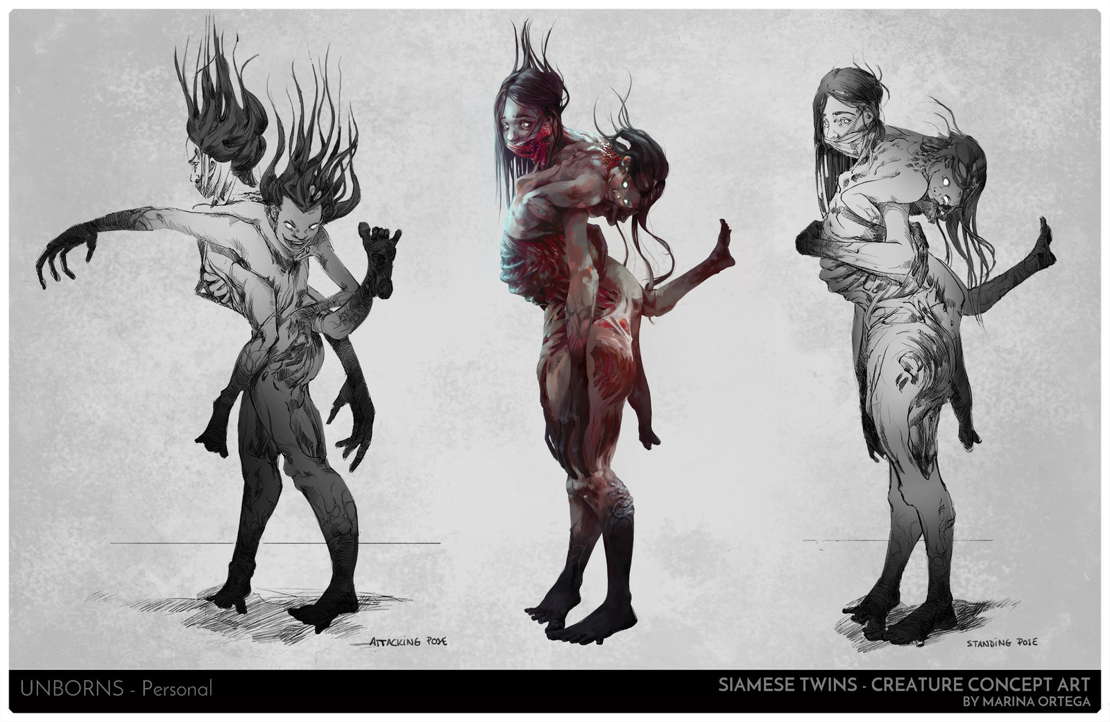 Unborn siamese twins