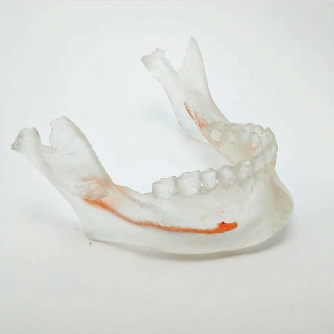 The dental surgeon then used this 3D print to see how to approach the surgery before even seeing the patient! We’re living in the future :)
