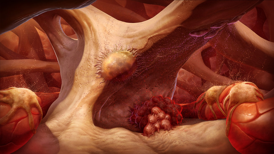 Bone Matrix: Prostate Cancer Metastasized