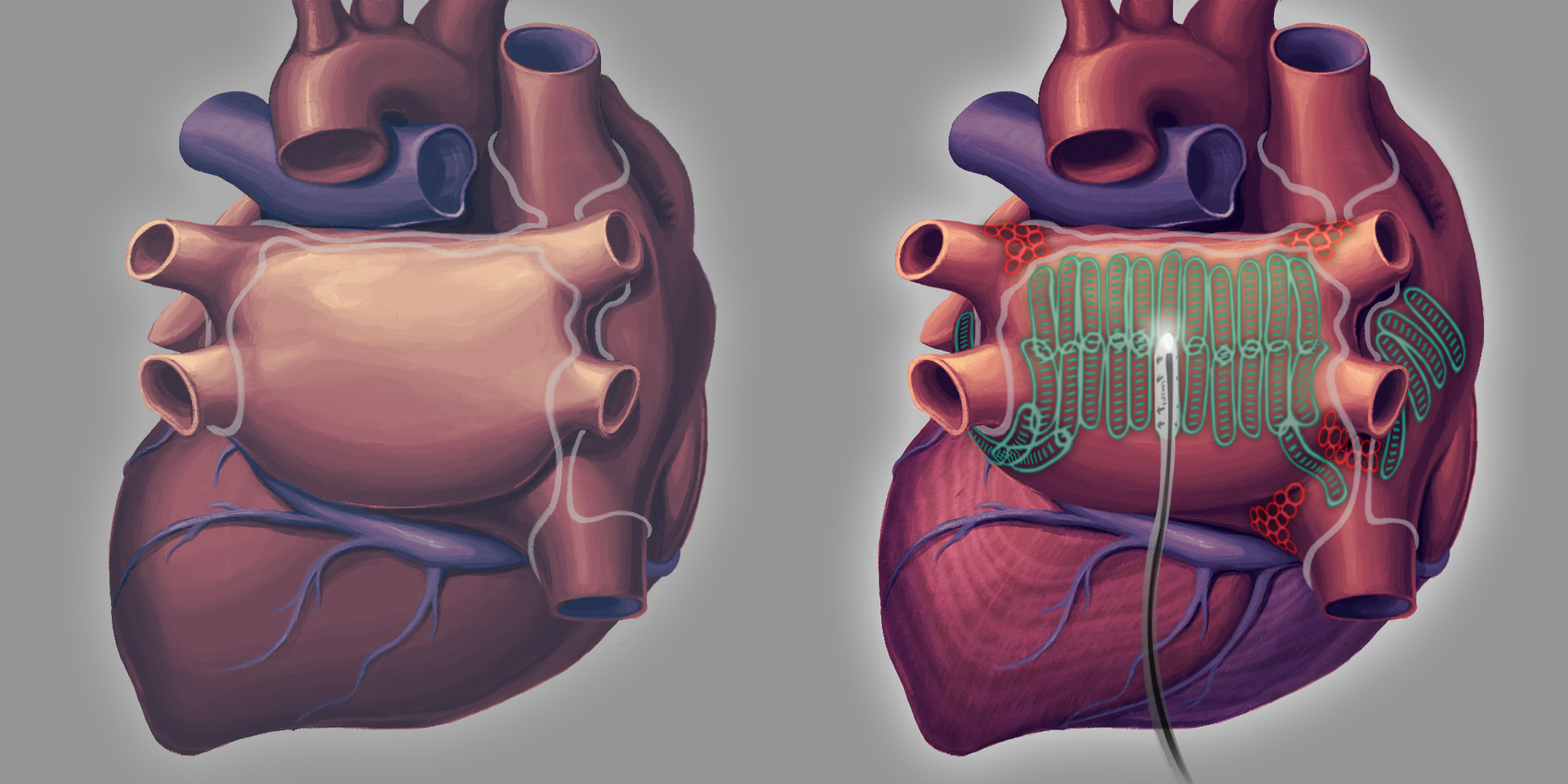 Artstation Heart Surgery Medical Illustration Cleveland Mosher