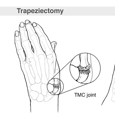 Trapeziectomy