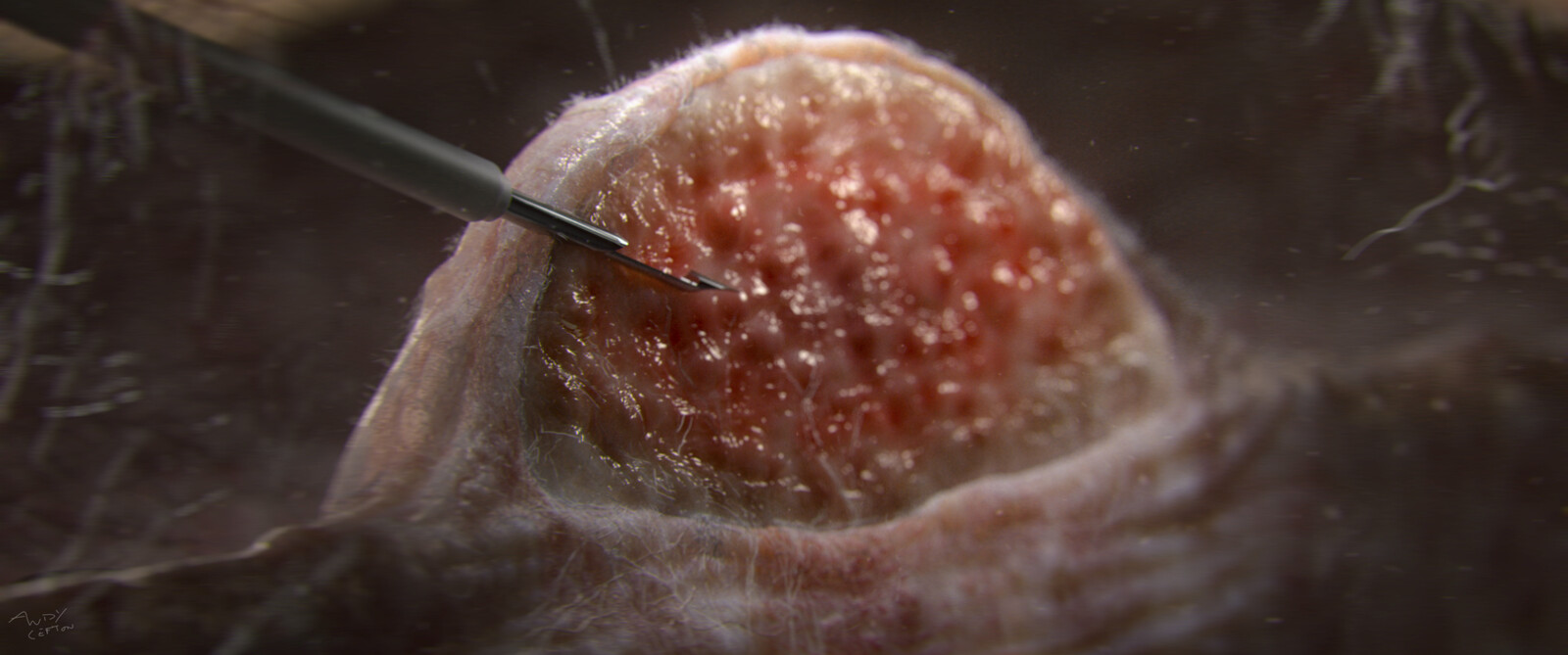 stomach lesion cross section (stylized)