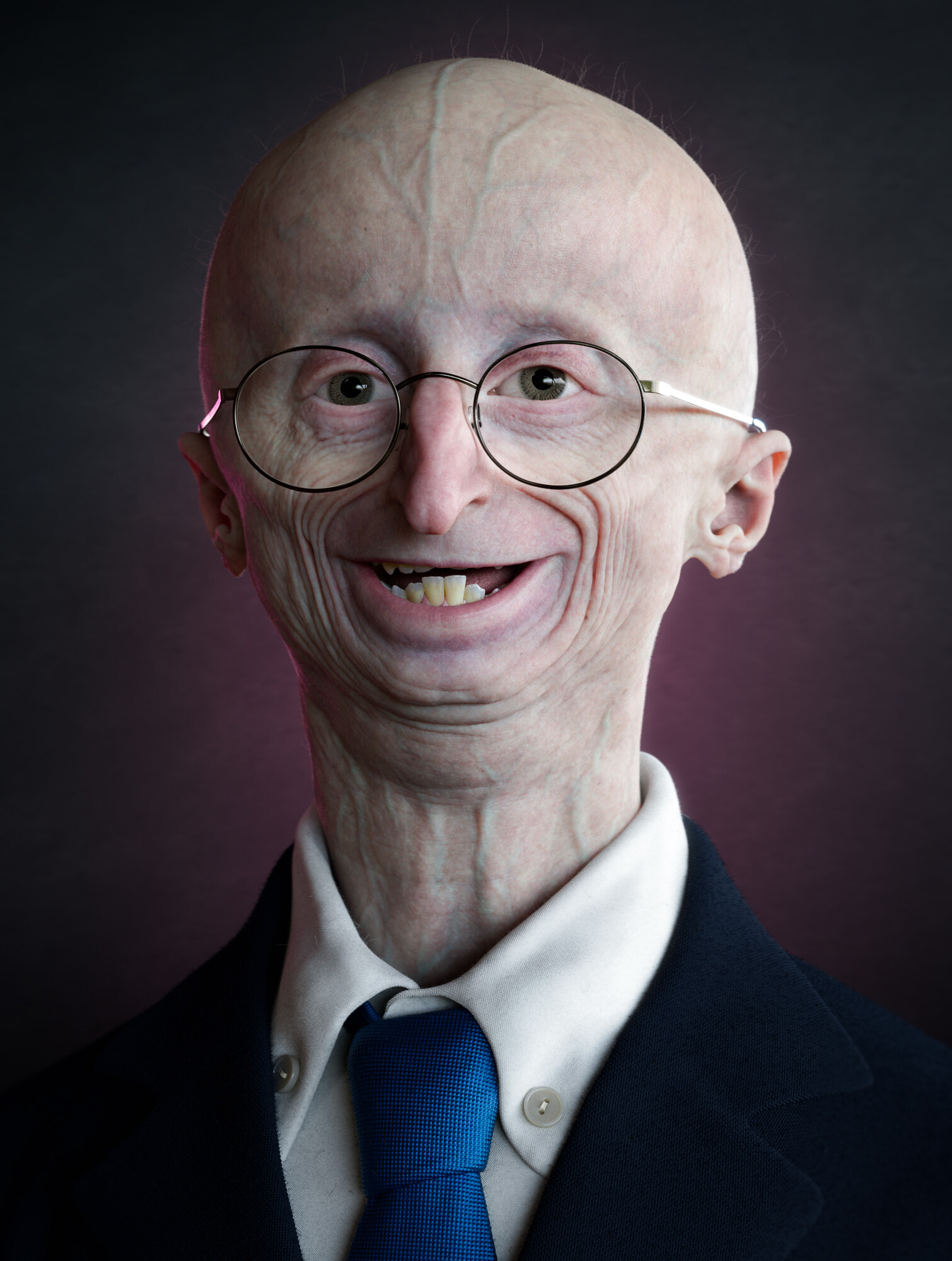 progeria sam berns