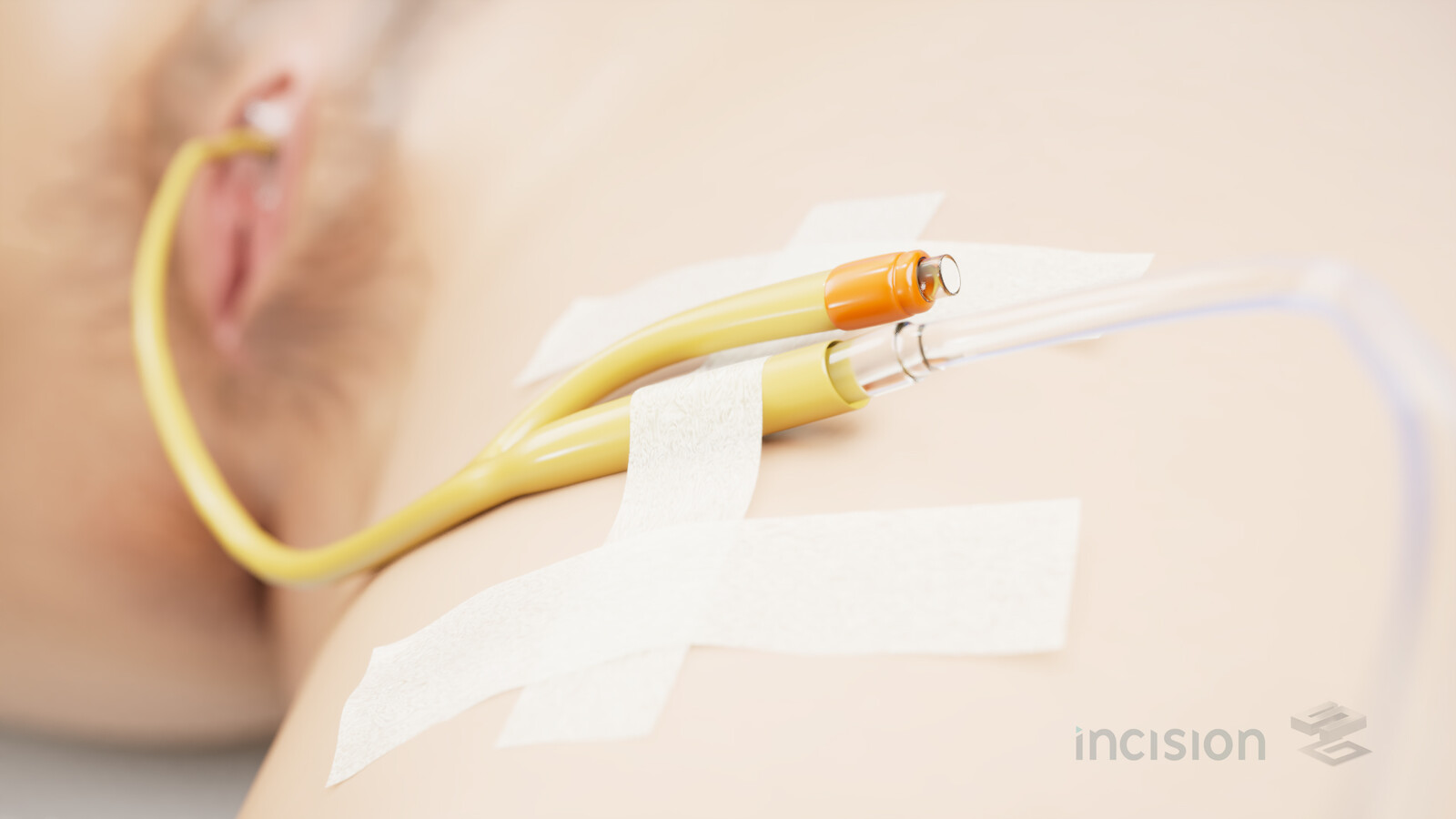 Bladder Catheterization - Final comp.