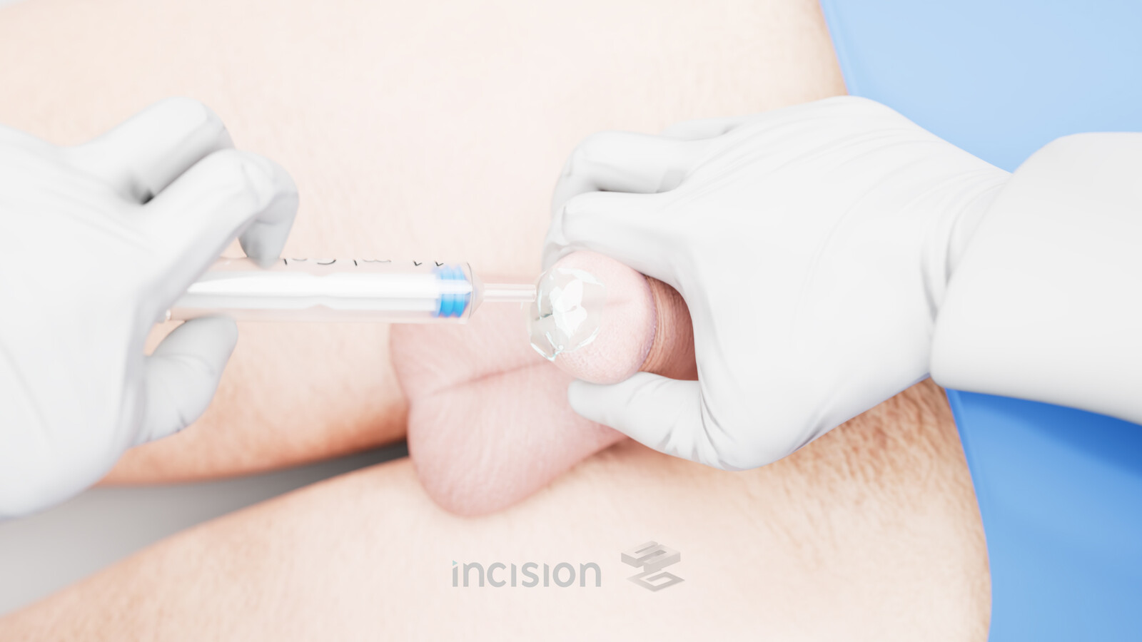 Bladder Catheterization - Final Comp.