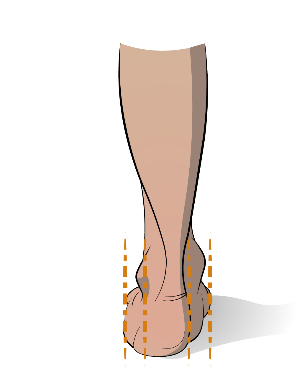Here's a range of illustrations for the FPI6 assessment; looking at how toe-in (or -out) the patient is. 