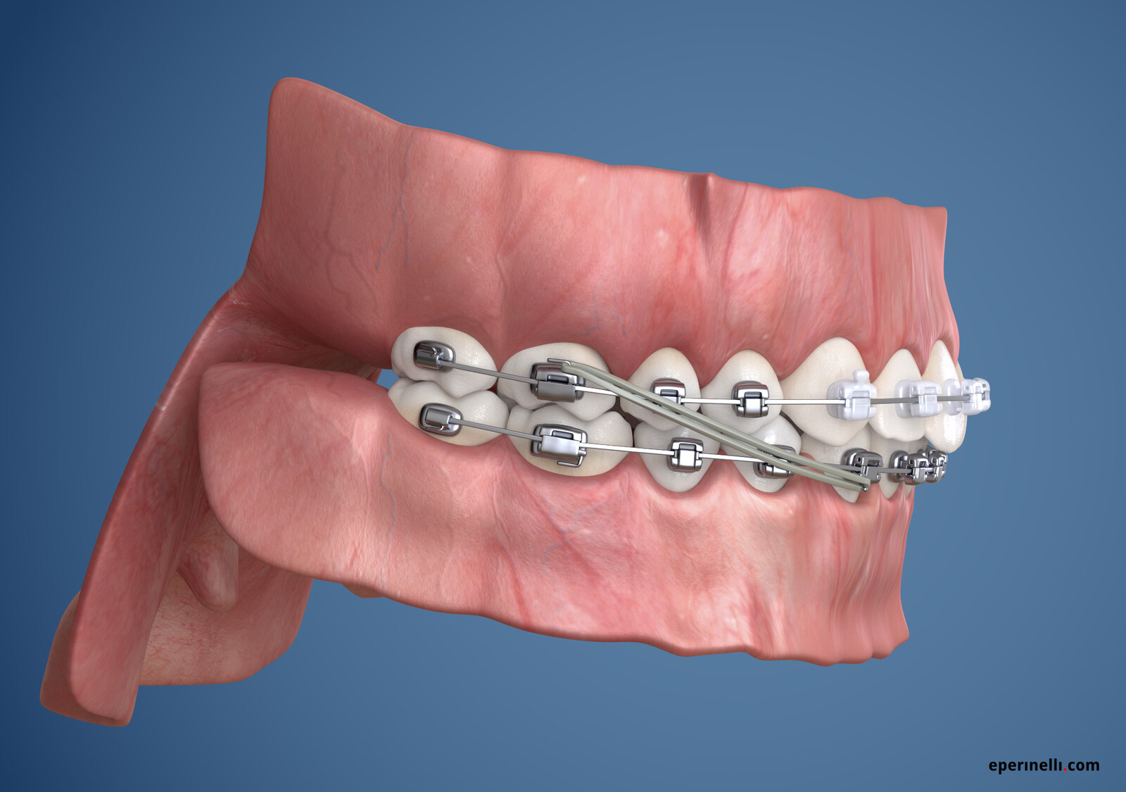 Brace system visualization