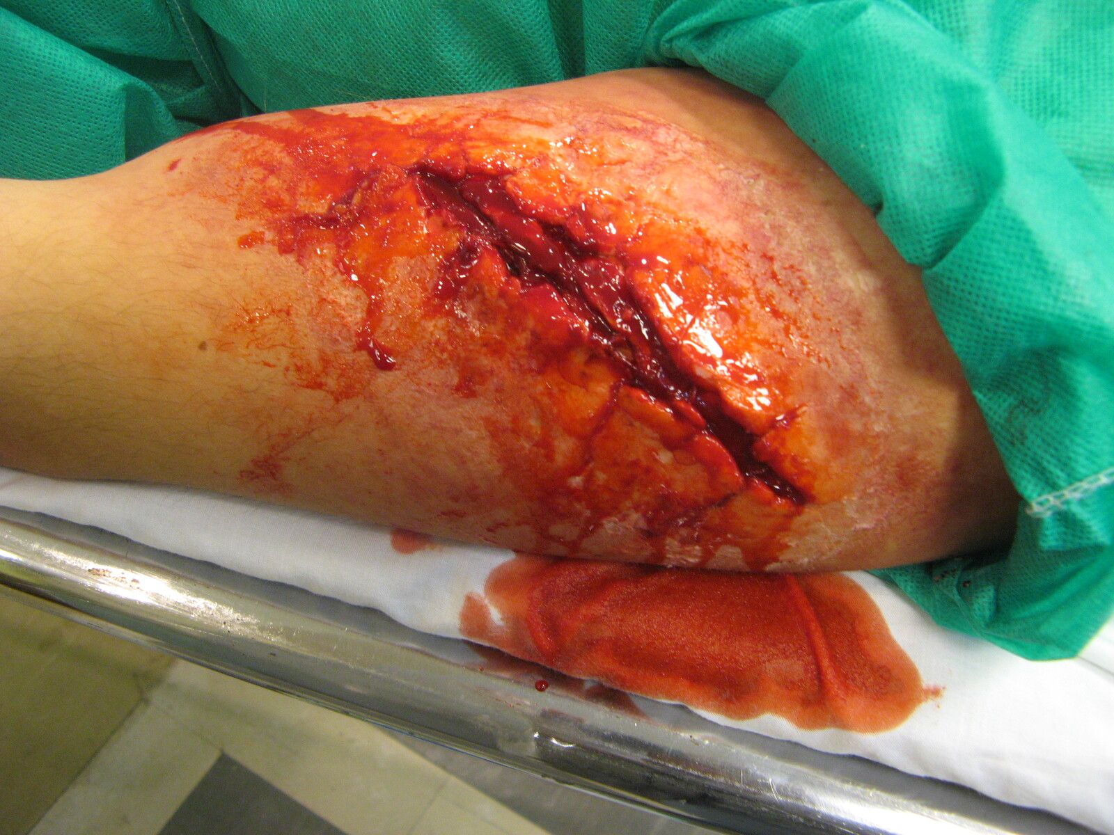 CRITICAL MOMENTS Arm Gash (OUT OF KIT AMY MILLS)
