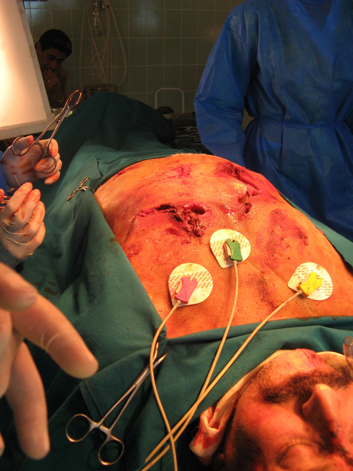 CRITICAL MOMENTS impaled chest for surgery scene
