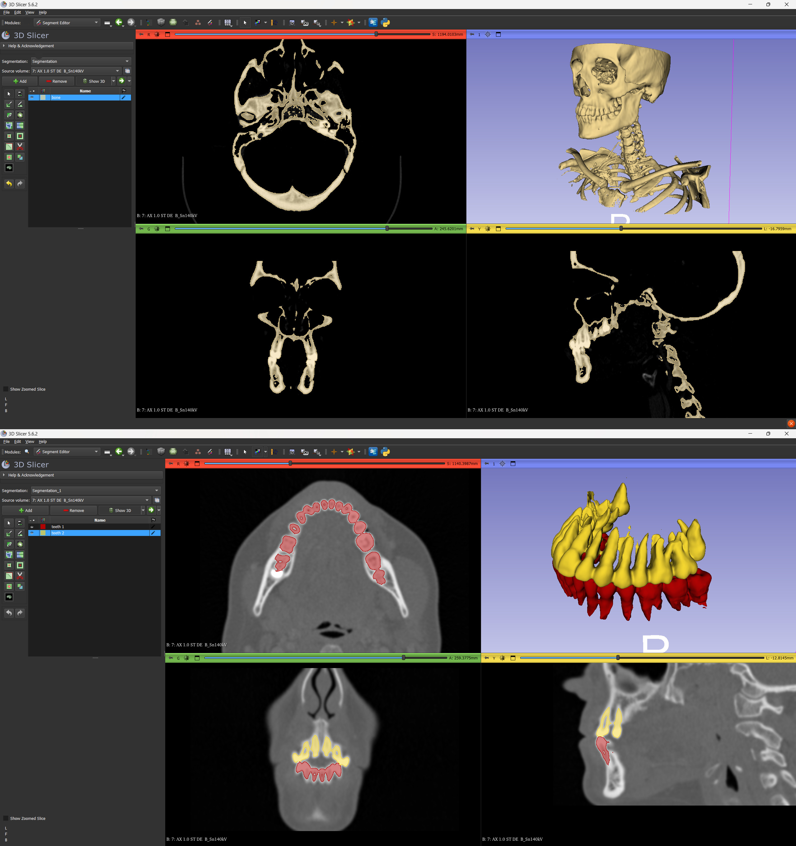 Segmenting the bone and separating the teeth in 3D Slicer