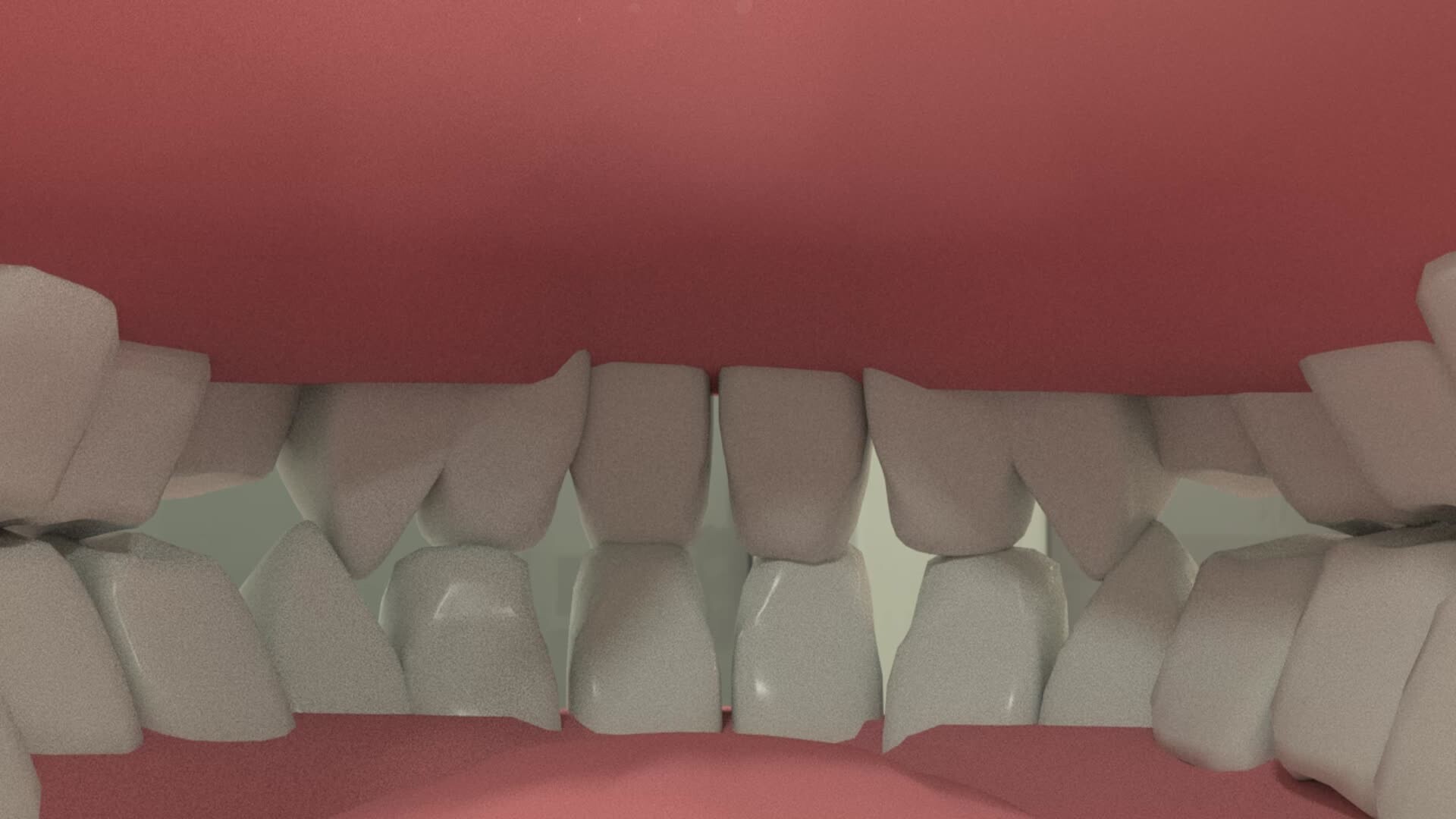 ArtStation Laser cavity removal (Demo)