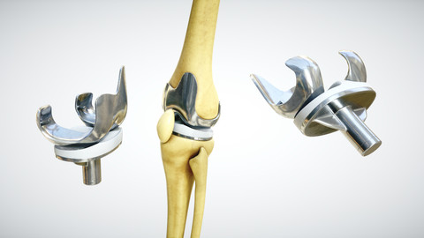 Knee endoprosthesis