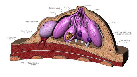 Anatomical female breasts model with common diseases for 3Dprinting