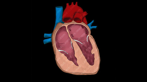 Right Ventricular Hypertrophy (Anterior View)