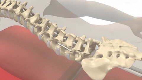 Human Spine and Implant