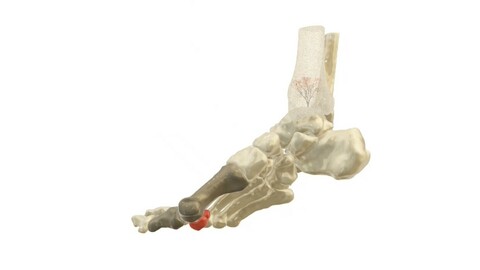 Foot bones, hallux valgus deformity, science and art, sports