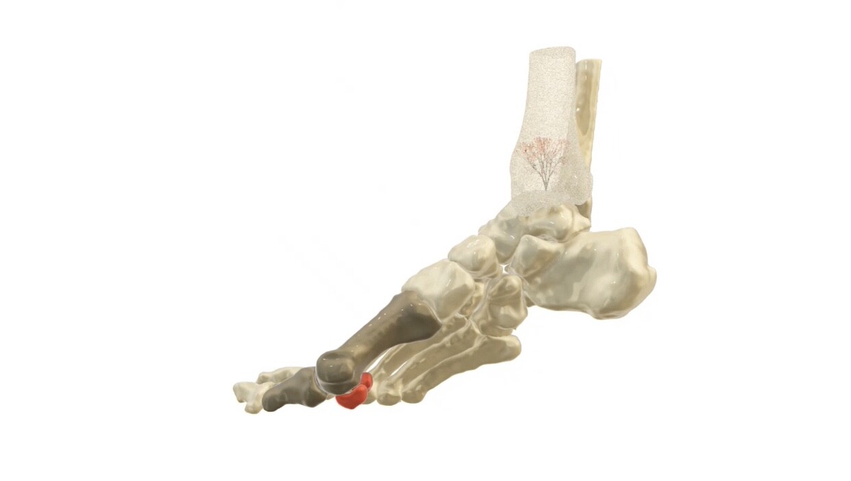 ArtStation Foot bones, hallux valgus deformity, science and art