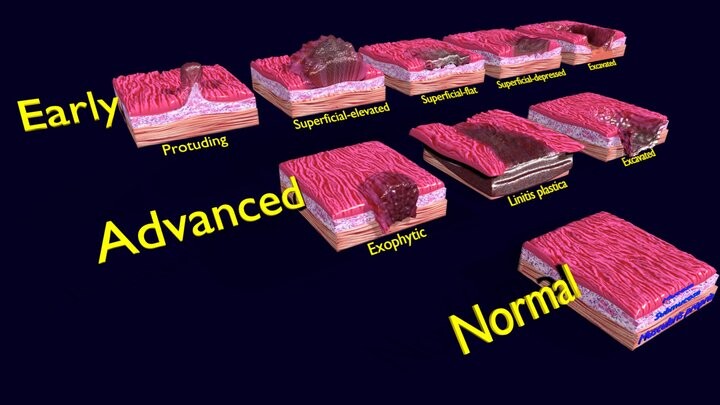 ArtStation - Gastric stomach cancer stages labelled | Resources