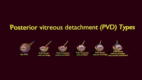 Vitreous detachment types posterior prolapse