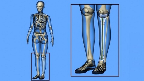 Tibial Intramedullary Nail