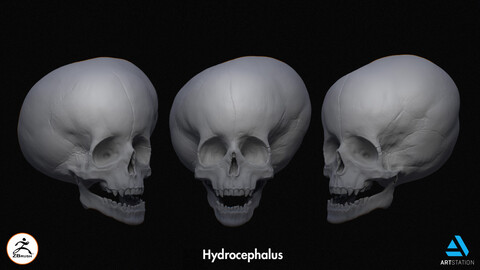 hydrocephalus - Skull Model