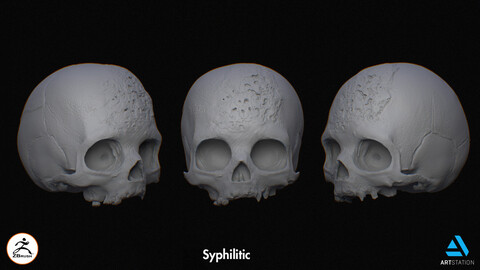 Syphilitic - Skull Model