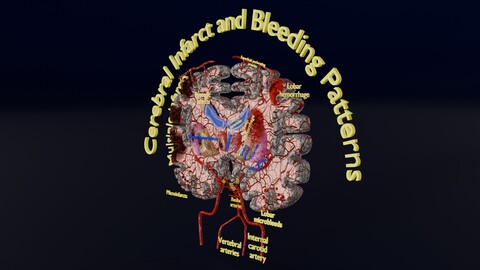 Stroke brain infarct hemorrhage types